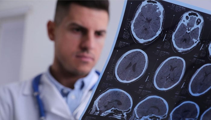 New study reveals link between multiple sclerosis and cancer risk