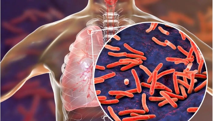 Tuberculosis surpasses COVID-19 as the most dangerous disease, WHO reports