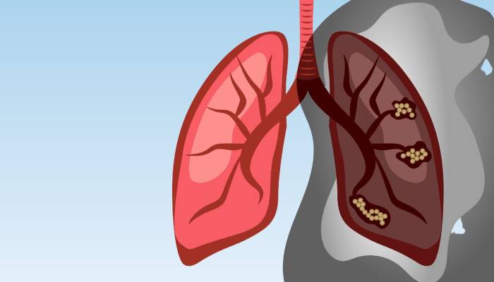 Lung cancer can affect non-smokers too: Hidden signs you need to know