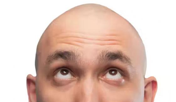  پُراسرار بیماری، متاثرہ افراد ایک ہفتے میں گنجے ہونے لگے