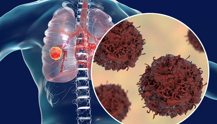 کبھی سگریٹ نوشی نہ کرنے والوں میں بھی پھیپھڑوں کے کینسر  میں اضافہ
