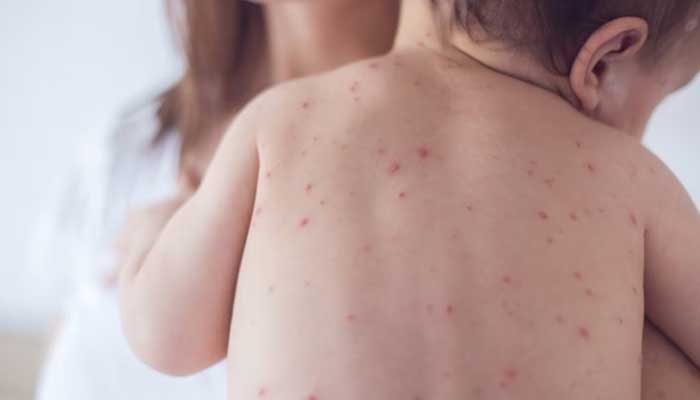 Measles outbreak in US causes first death in a decade