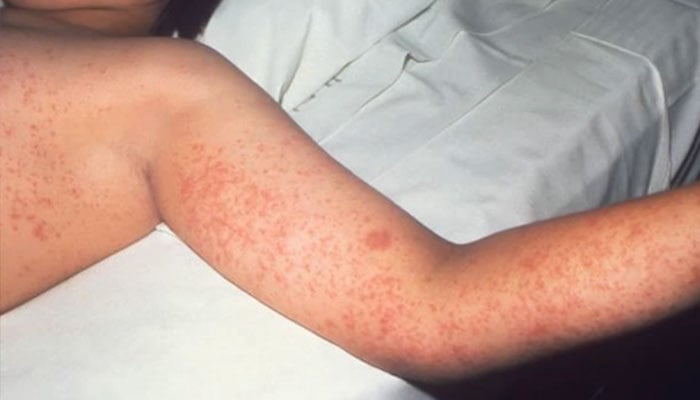 US CDC reacts to ongoing measles outbreak in Texas