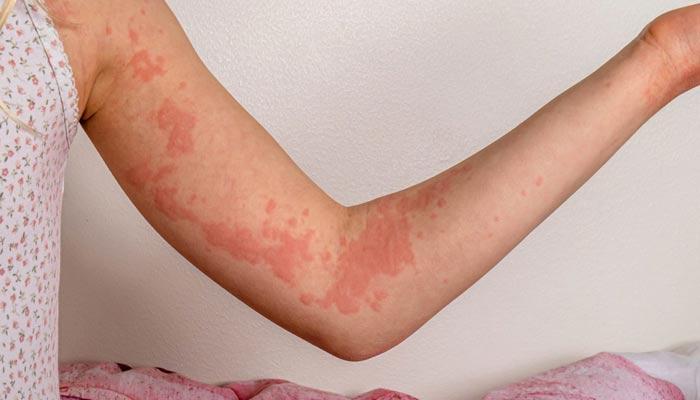 Study reveals Remibrutinib effective to treat Chronic Spontaneous Urticaria