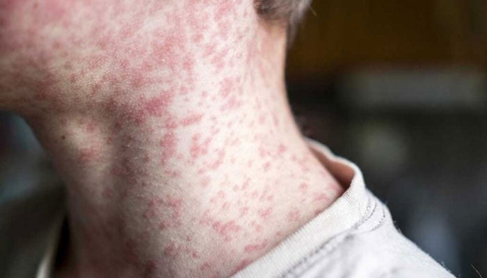 Measles in Europe: Number of cases reach all-time high in 25 years