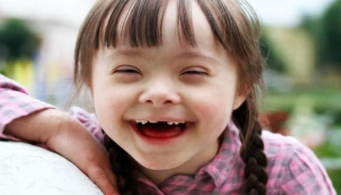 World Down Syndrome Day 2025: Treatment, causes, symptoms