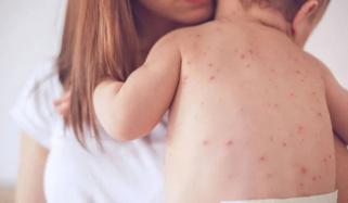  ٹیکساس میں  خسرہ کی وباء شدت اختیار کر گئی