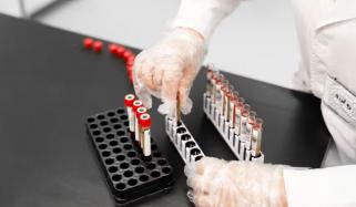 علامات ظاہر ہونے سے قبل ٹیسٹ پارکنسنز کا پتہ لگانے میں معاون