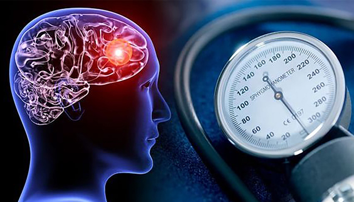 Treating hypertension reduces dementia risk, study reveals