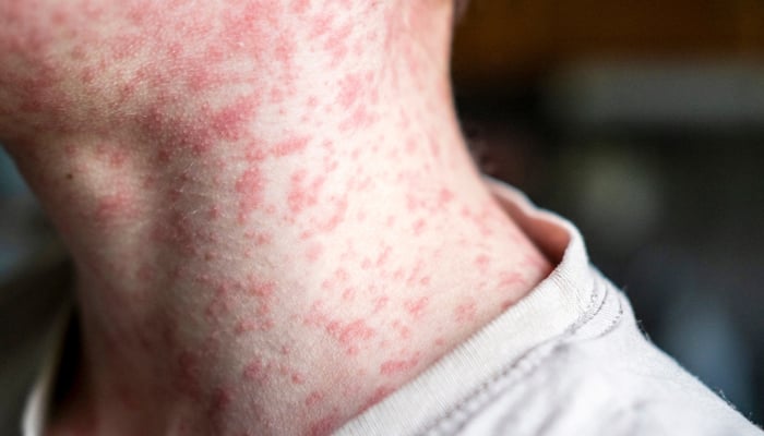 US measles case tally approaches 900, outbreaks reported in 10 states