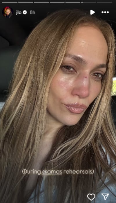 Jennifer Lopez suffers painful injury ahead of 2025 American Music Awards