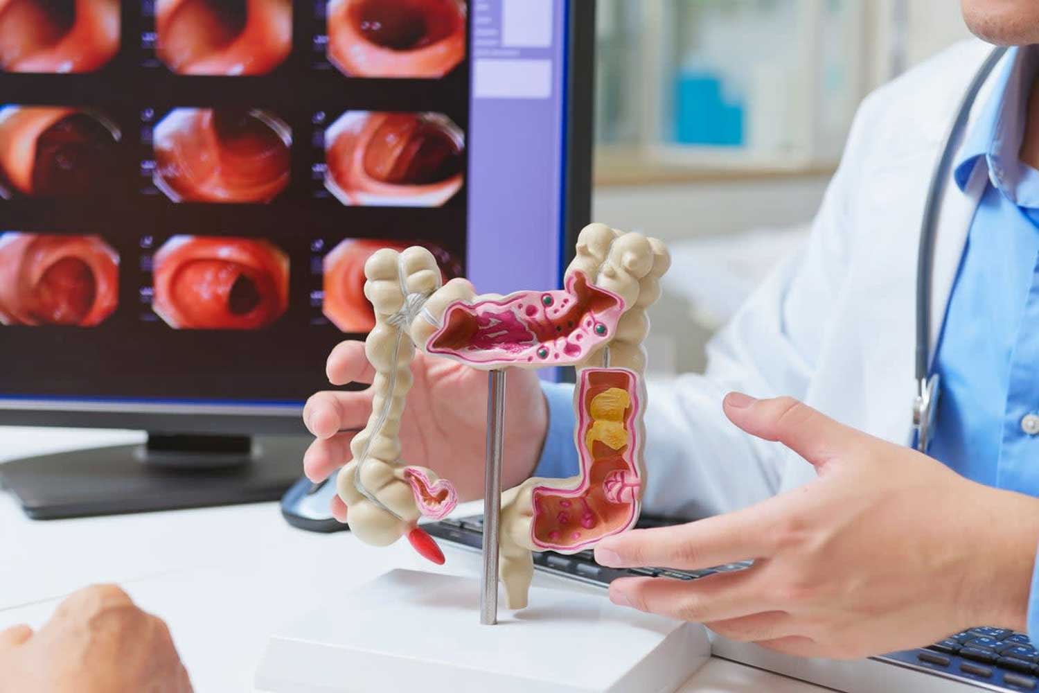 Bowel cancer surge in young people: Scientists make groundbreaking discovery