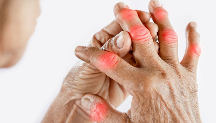 Researchers find an exponential rise in Rheumatoid Arthritis cases worldwide