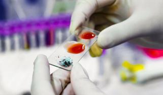 فرانس کے سائنسدانوں نے نیا بلڈ گروپ دریافت کرلیا