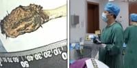 52 برس بعد چینی شخص کی آنت سے ٹوٹھ برش نکال لیا گیا