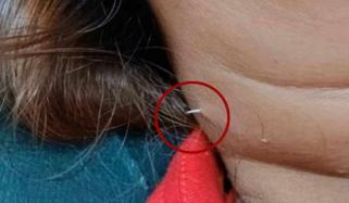 تھائی خاتون نے مچھلی کھائی، کانٹا گردن چیر کر باہر نکل آیا