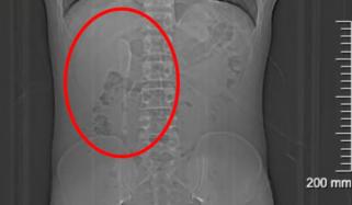 چینی آدمی کے پیٹ سے 6 ماہ بعد 15 سینٹی میٹر کا چمچ نکال دیا گیا