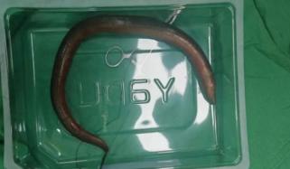 چین: ایک شخص کے پیٹ سے زندہ مچھلی نکال لی گئی، ڈاکٹرز بھی حیرت زدہ