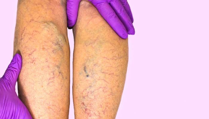 What is chronic venous insufficiency, condition affecting Donald Trump