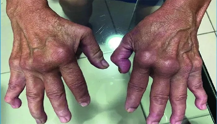 چکن گونیا سے جسمانی اعضا پر مرتب ہونے والے اثرات(تصویر سوشل میڈیا)۔