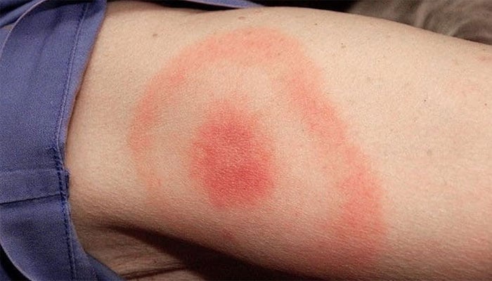 What is Lyme disease? Symptoms, diagnosis, and treatment