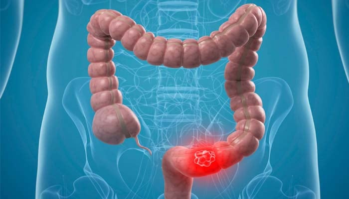 5 signs of colon cancer you should never ignore