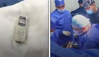 مصر میں ایک شخص نے موبائل فون نگل لیا