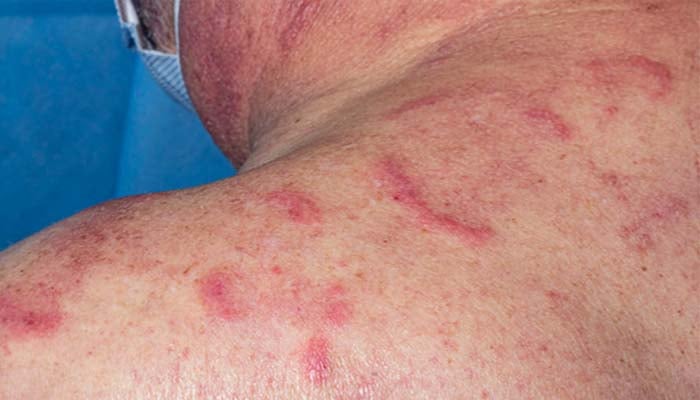 What is VEXAS syndrome? Rare genetic condition associated with inflammation