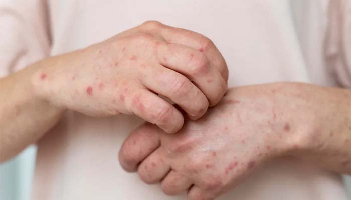 Valley fever cases surge in California: Symptoms, vulnerable population