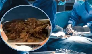 چین میں 15 سالہ لڑکی کے معدے سے 2 کلو بالوں کا گچھا نکال لیا گیا