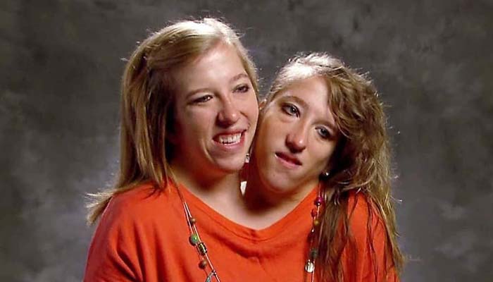 Conjoined twins Abby, Brittany Hensels inspirational journey of resilience