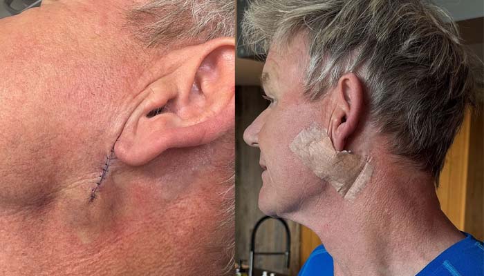Gordon Ramsay makes shocking revelation of skin cancer diagnosis