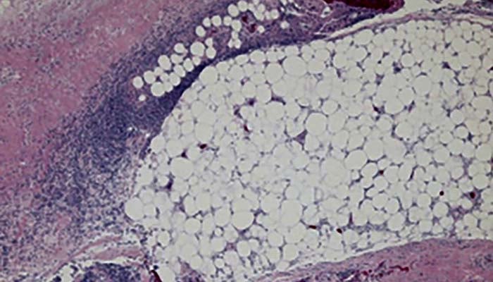 Flesh-eating bacteria killed 2 more people in Louisiana
