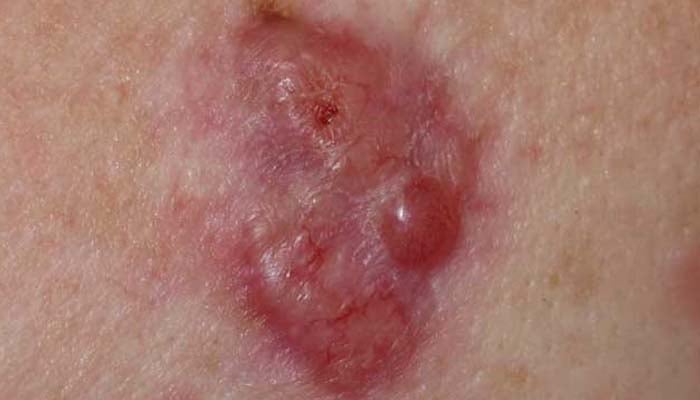 What is Basal Cell Carcinoma? Symptoms, causes, types