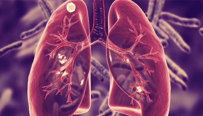 Maine CDC confirms 3 cases of Tuberculosis in Portland area
