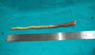 80 سالہ شخص کی غذائی نالی سے 9 انچ لمبی ٹوتھ پک نکال لی گئی