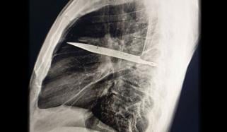 سینے میں ٹوٹے ہوئے چاقو کے ساتھ 8 سال زندہ رہنے والا آدمی