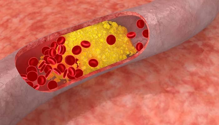 How to prevent atherosclerosis naturally with simple lifestyle changes