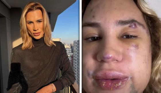 خوبصورت نظر آنے کی خواہش انفلوئنسر کی جان لے گئی