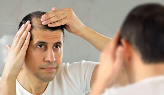 گنج پن یا بال جھڑ کا علاج ایک پودے میں پوشیدہ 