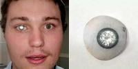 امریکی جیولر نے اپنی مصنوعی آنکھ میں قیمتی ہیرا جڑوا لیا