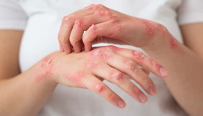 Family stress during early-life may significantly increase psoriasis risk