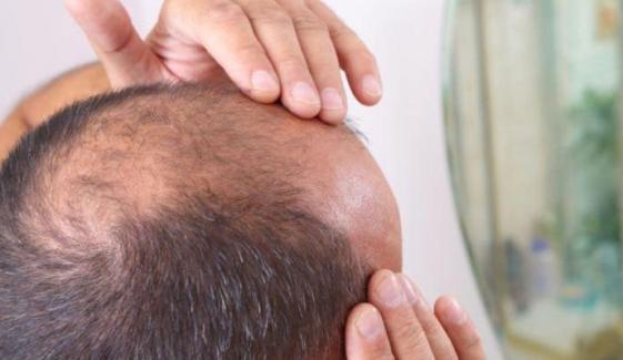 گنج پن کا آسان علاج دریافت، 20 دن میں بالوں کی واپسی ممکن