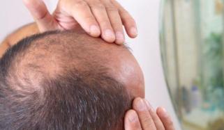 گنج پن کا آسان علاج دریافت، 20 دن میں بالوں کی واپسی ممکن