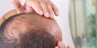 گنج پن کا آسان علاج دریافت، 20 دن میں بالوں کی واپسی ممکن