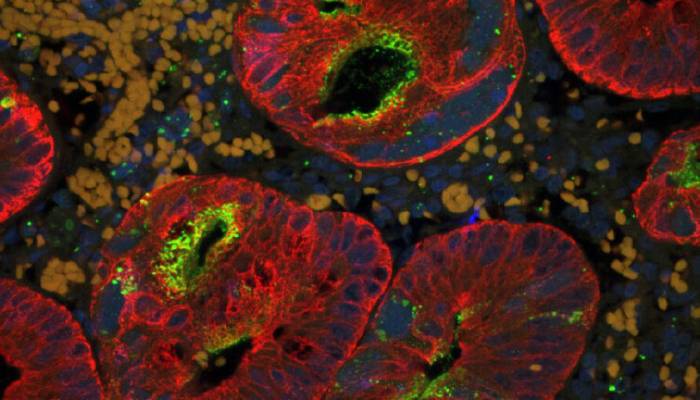 Canada’s measles outbreak causes Americas region to lose elimination status