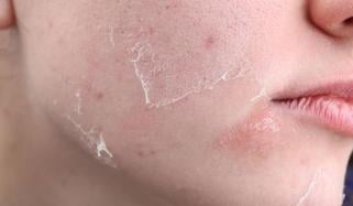 سردیوں میں جلد کو خشک ہونے سے بچانے کیلئے آسان طریقے