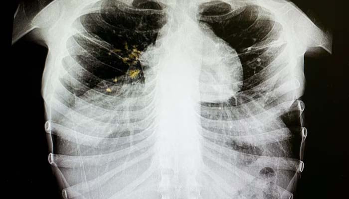 Provincial health officials declare Tuberculosis outbreak in Edmonton