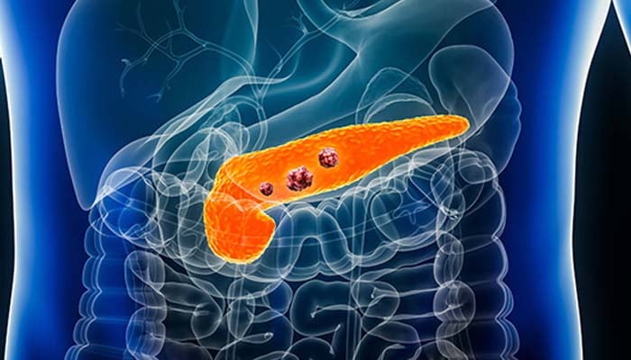 Are you at higher pacreatic cancer risk? Heres new warning sign