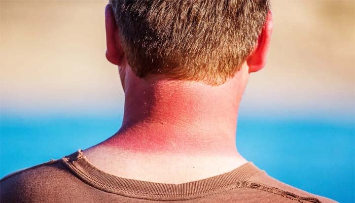 UV rays triggers inflammation that can cause skin cancer, study